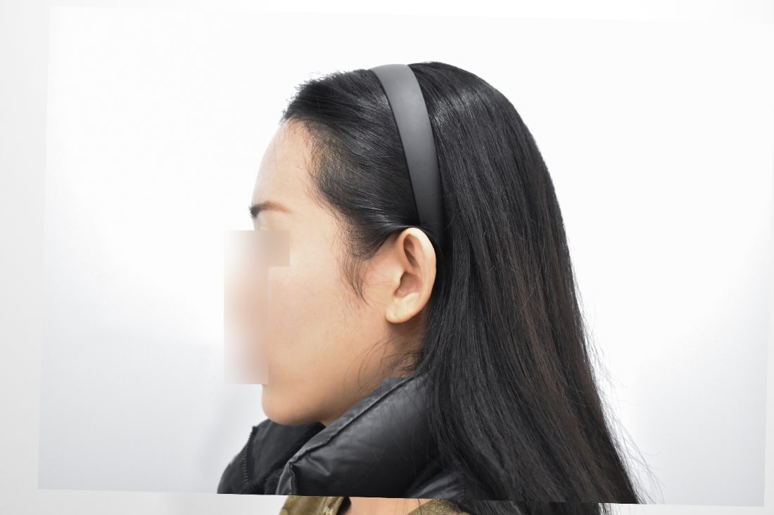 Bệnh nhân 1 độn trán sau — góc nghiêng