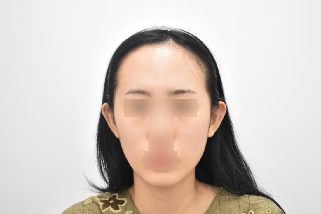 Bệnh nhân 1 độn trán trước — góc chính diện