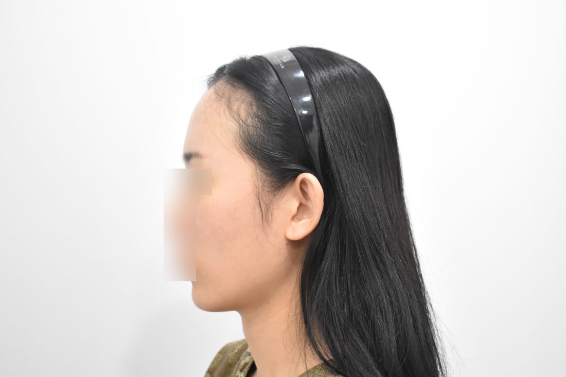 Bệnh nhân 1 độn trán trước — góc nghiêng
