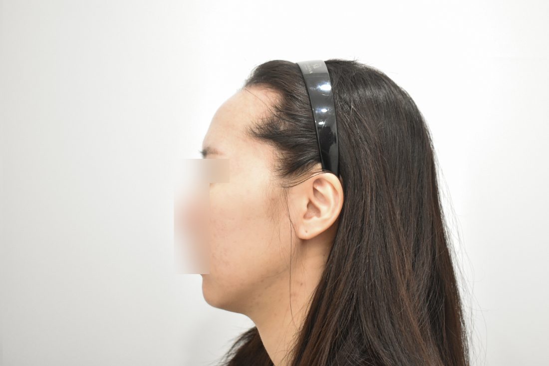 Bệnh nhân 2 độn trán trước — góc nghiêng